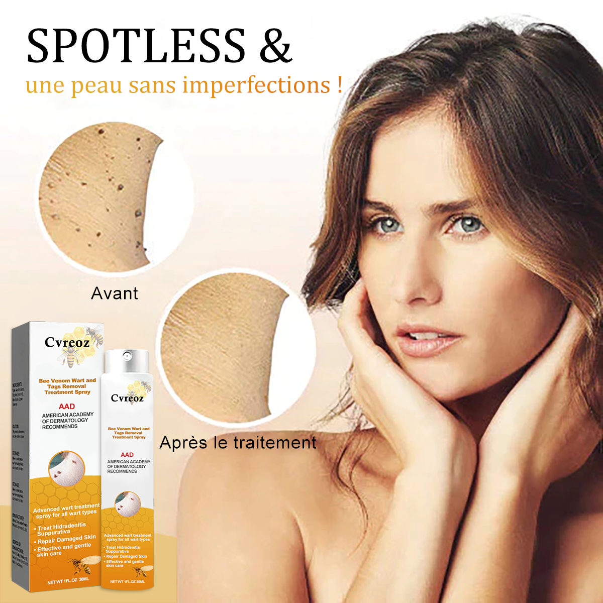 🧡 Cvreoz Spray de Traitement pour l'Élimination des Verrues et des Étiquettes Cutanées au Venin d'Abeille(👨‍⚕LE DAA RECOMMANDE)🐝🐝(🔥Promotion du dernier jour 80% de réduction)