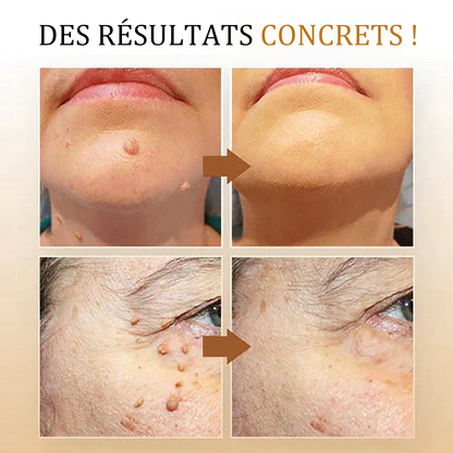 🧡 Cvreoz Spray de Traitement pour l'Élimination des Verrues et des Étiquettes Cutanées au Venin d'Abeille(👨‍⚕LE DAA RECOMMANDE)🐝🐝(🔥Promotion du dernier jour 80% de réduction)